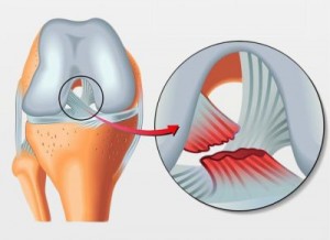 JOELHO-LIGAMENTO-CRUZADO-ANTERIOR-imagem